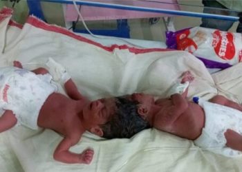 A daughter was born with a pair of heads