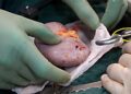 Successful Kidney Transplants Conducted in Tripura