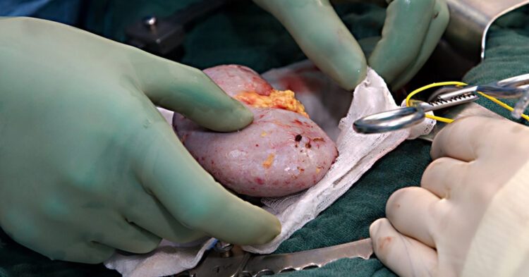 Successful Kidney Transplants Conducted in Tripura