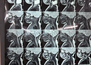 43-Day-Old Baby Undergoes Rare Branchial Cyst Surgery in Amarpur