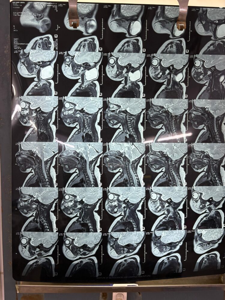 43-Day-Old Baby Undergoes Rare Branchial Cyst Surgery in Amarpur