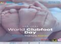 World Clubfoot Day: Experts Highlight Benefits of Ponseti Method