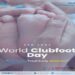 World Clubfoot Day: Experts Highlight Benefits of Ponseti Method